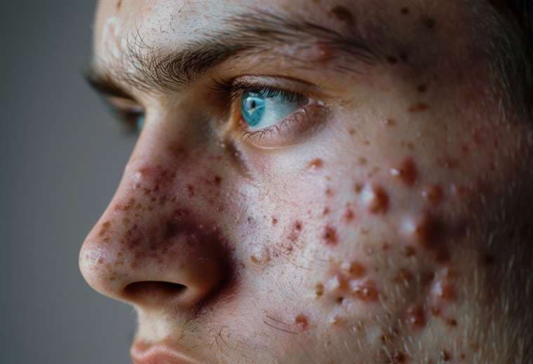 Tratamiento oportuno, la clave para evitar secuelas del acné severo 